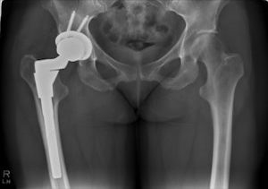 An x-ray film of a hip bone